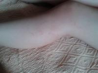 Сыпь в виде кольца что это Сыпь в виде кольца что это