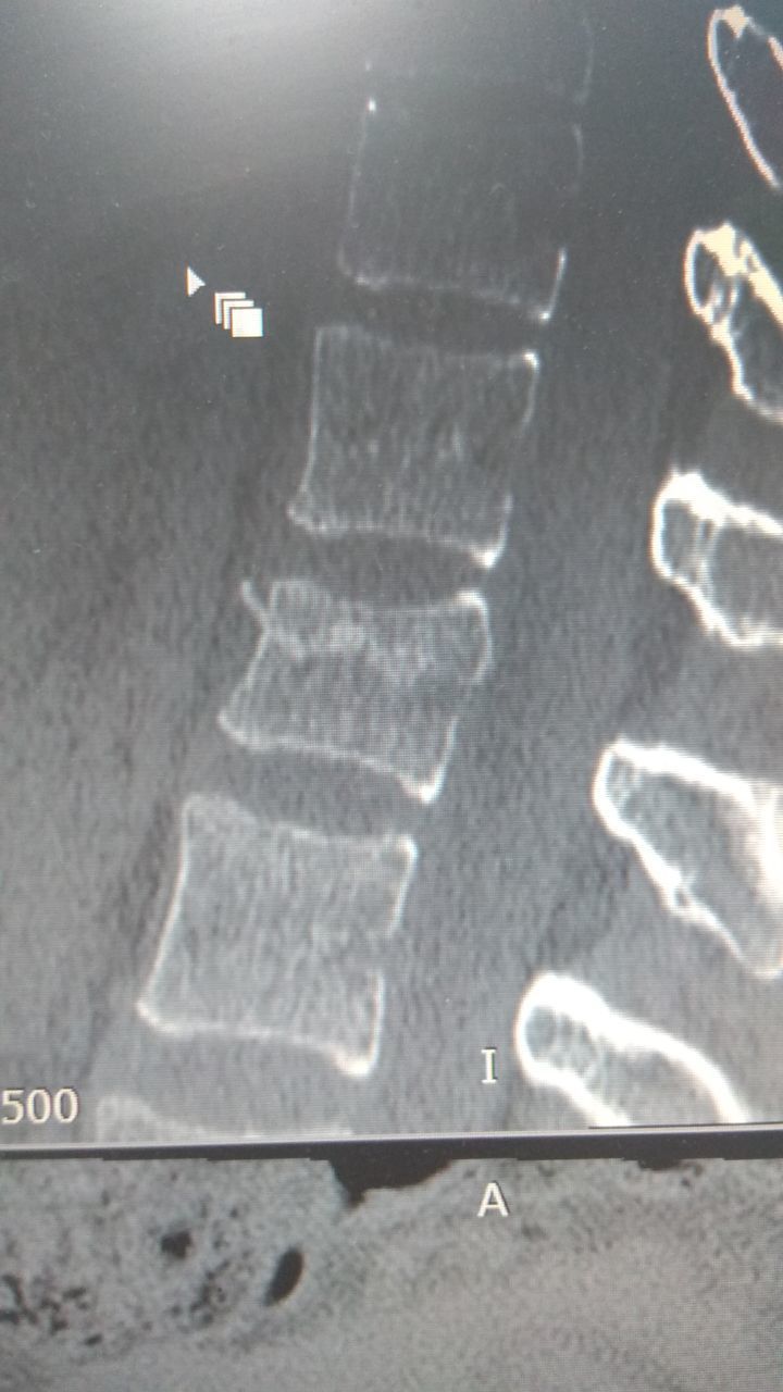 Компрессионный перелом позвоночника l1. Компрессионный перелом позвоночника 1 степени. Компрессионный перелом 6 позвонка.