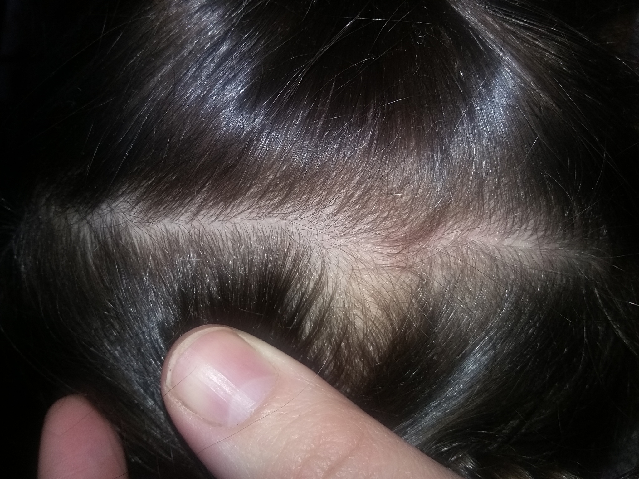 Сильное выпадение волос на голове