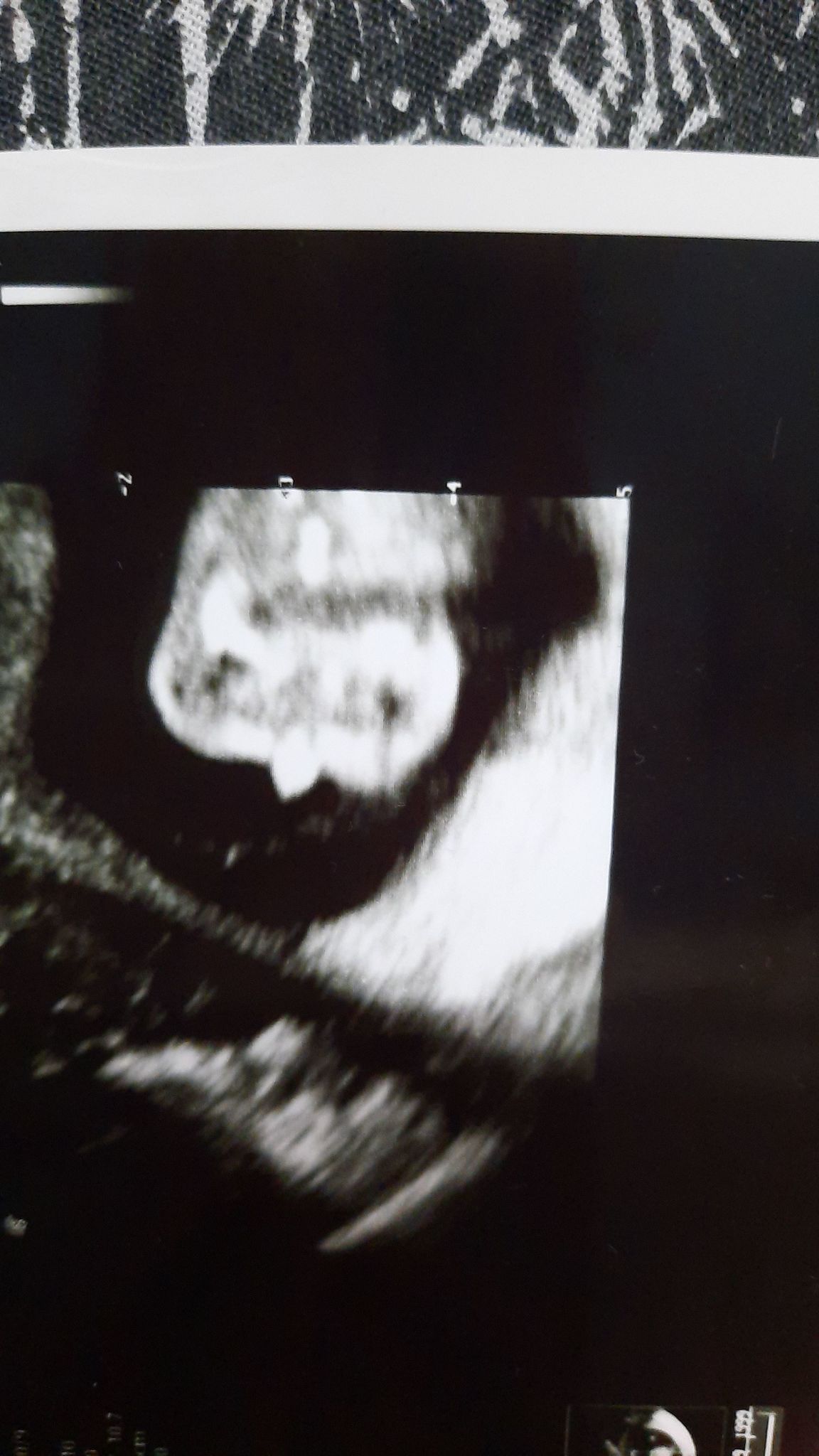 15 Недель беременности пол ребенка фото