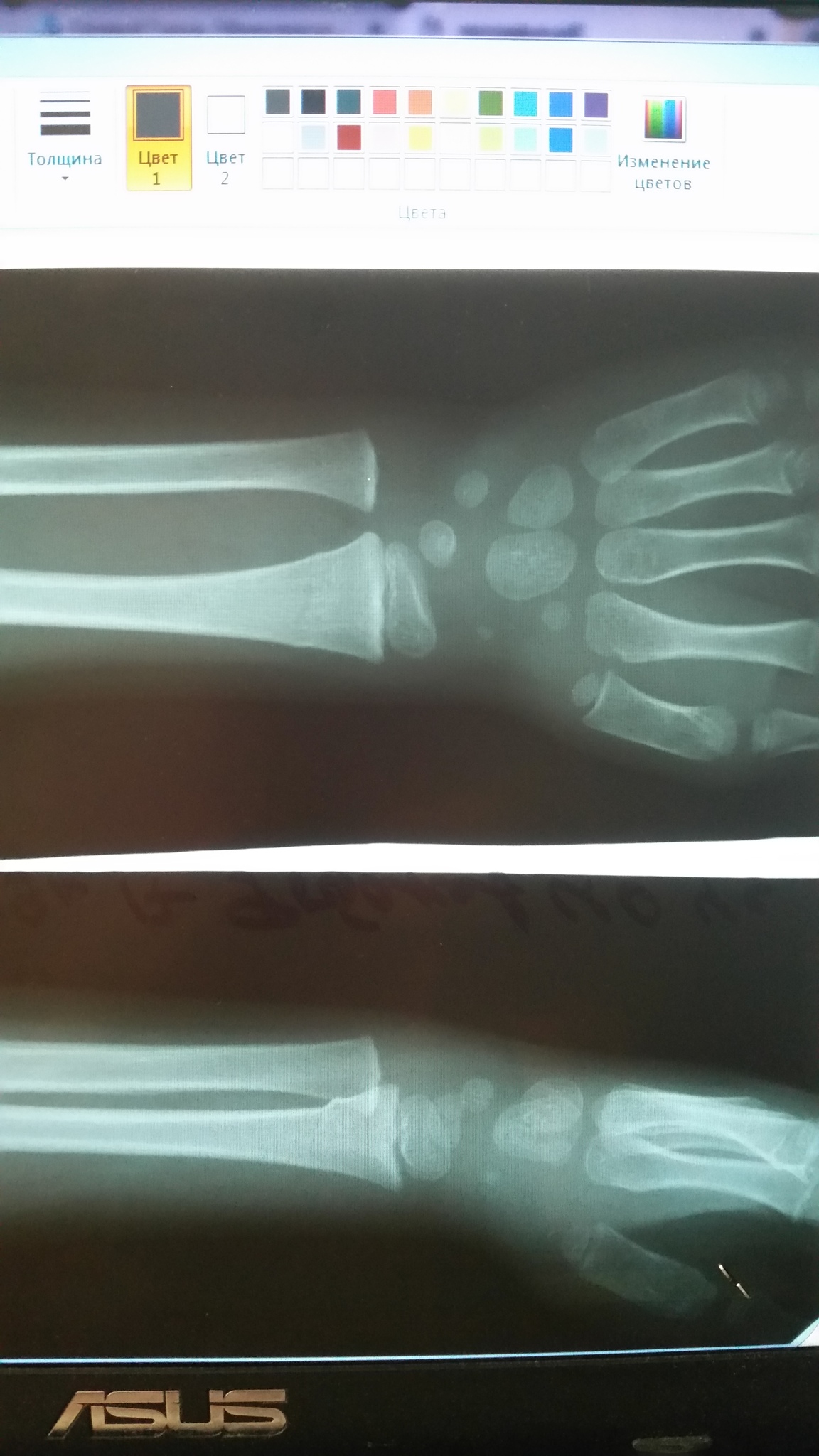 Перелом лучевой кости со смещением рентген