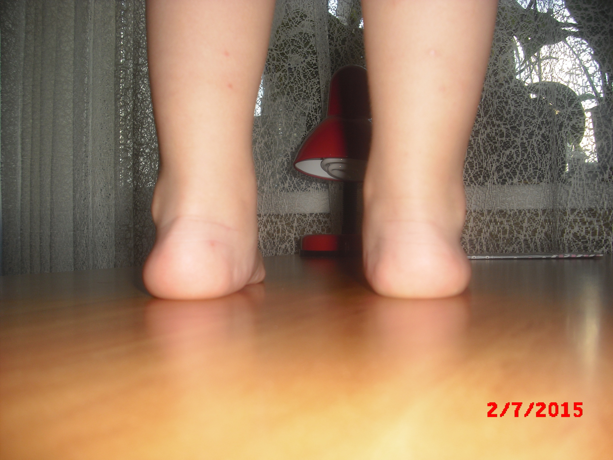 Высокий подъем стопы у ребенка