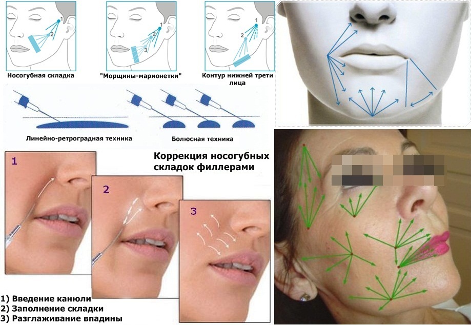 Схема уколов липолитика в лицо