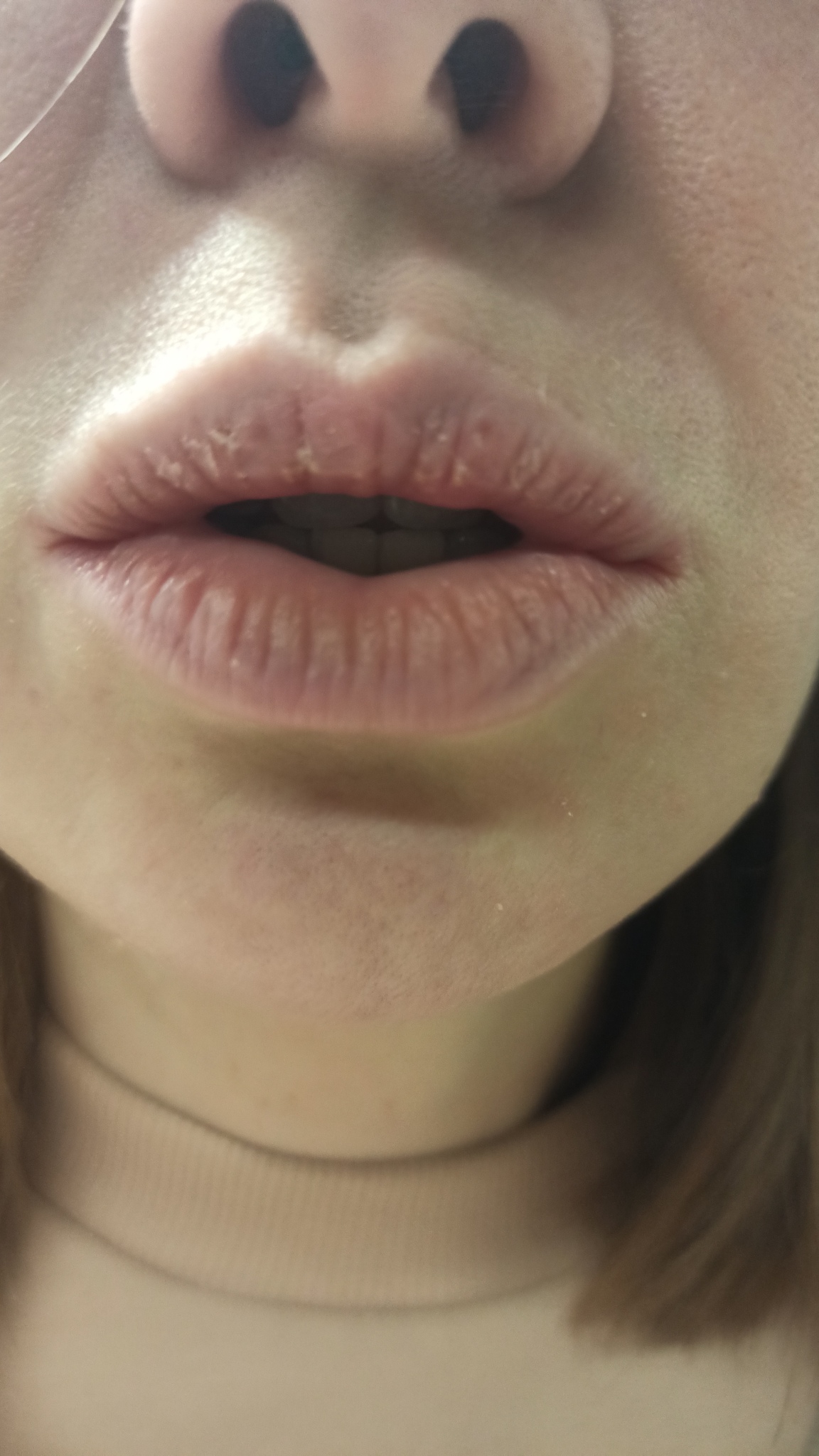 Почему сохнут губы: причины и способы лечения