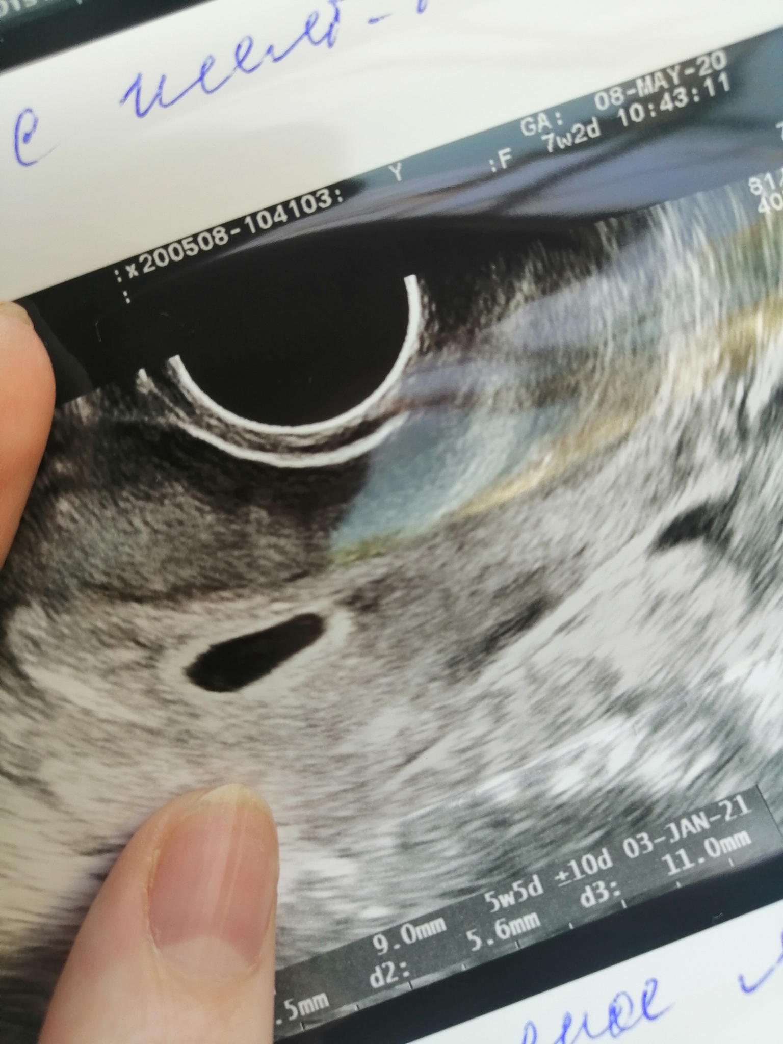 Беременность анэмбриония