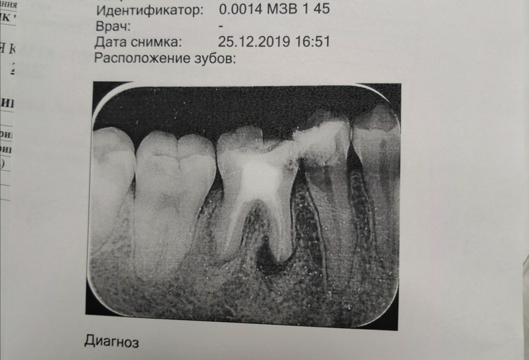 Можно ли делать снимок зуба. Снимок зуба расшифровка. Рентгеновский снимок зубов расшифровка. Расшифровка снимка зубов. Рентген зуба расшифровка.