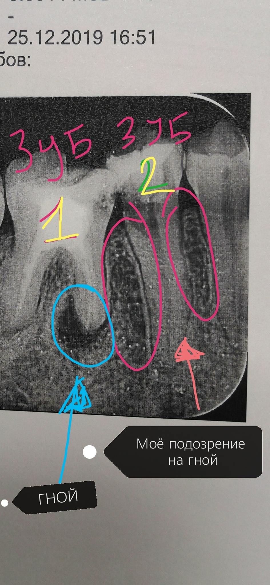 Расшифровать рентген зуба